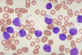 Լեյկոզ. գիտնականները քաղցկեղը նորմալ բջիջների են վերածել. med.news.am