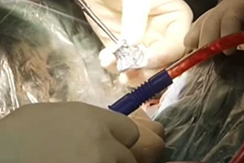 Сенсация: японские врачи имплантировали 3D-позвоночник