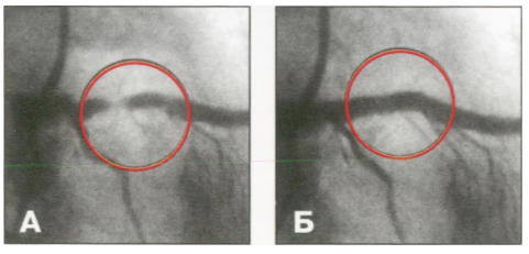 ԵՊԲՀ «Հերացի» թիվ 1 համալսարանական հիվանդանոցն իջեցնում է սրտի ստենտավորման գները
