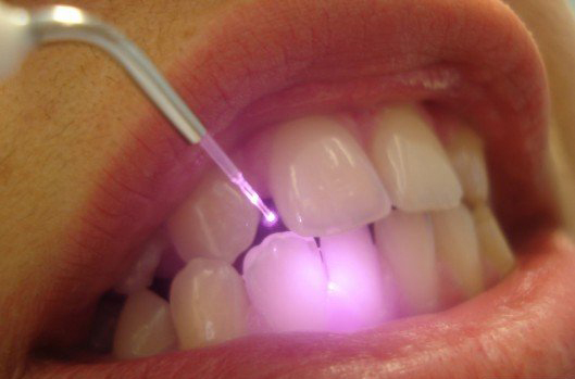 Лазерные технологии изменят ваше представление о лечении зубов