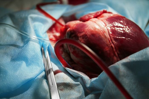 Врачи пересадили сердце пациентке с редкой генетической мутацией