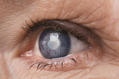Исследователи приблизились к излечению глаукомы с помощью пересадки клеток