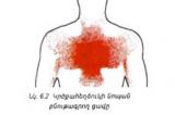 Կրծքահեղձուկի (ստենոկարդիա) նոպա և սրտամկանի ինֆարկտ