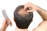 Նոր միջոցը ճաղատացած մարդկանց օգնում է վերականգնել մազերի 90 տոկոսը. news.am