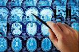 Этот тест на интеллект покажет, выживет ли пациент после инсульта