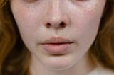 Синдром поликистозных яичников: ранний признак можно увидеть на лице
