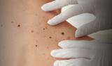 Самая смертоносная форма рака кожи — не меланома, выяснили ученые