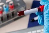 Канадские ученые разработали методику выявления депрессии по анализу крови