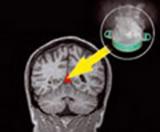 В мозге обнаружен центр лихорадки