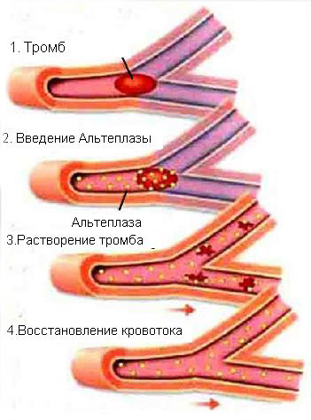 Как растворить тромб