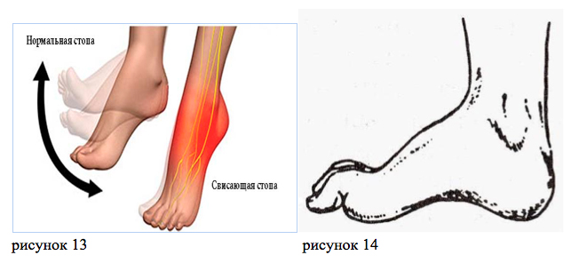 Невропатия стопы. Неврит большеберцового нерва. Нейропатия большеберцового нерва. Повреждение большеберцового нерва. Повреждение поверхностного малоберцового нерва.