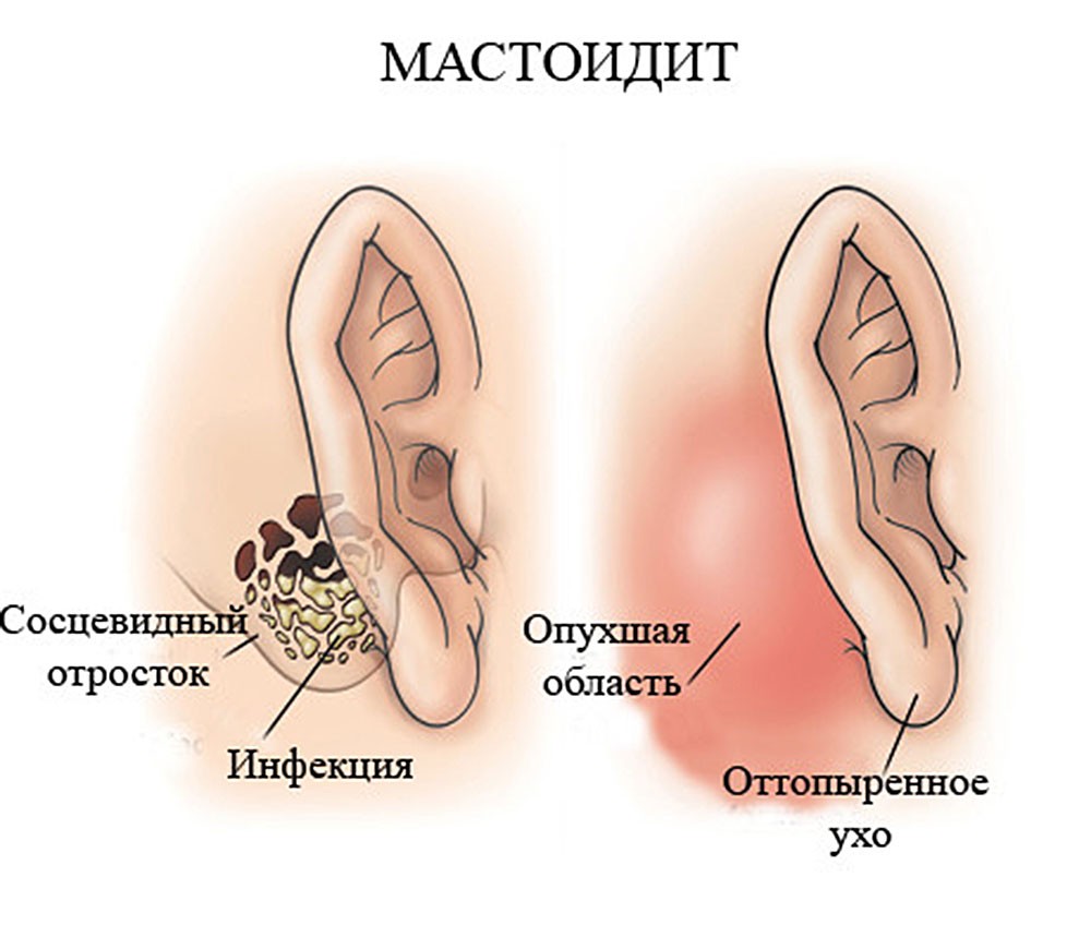 Утолщение слизистой сосцевидного отростка