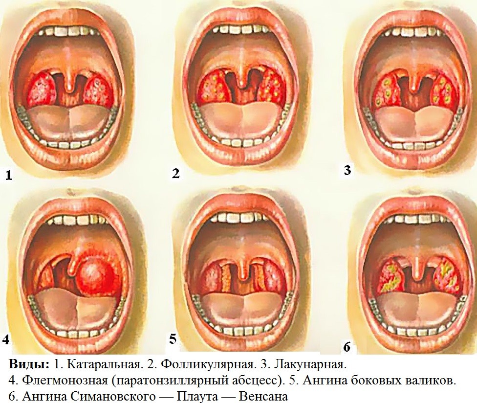 Как лечить увеличенные лимфоузлы при ангине?