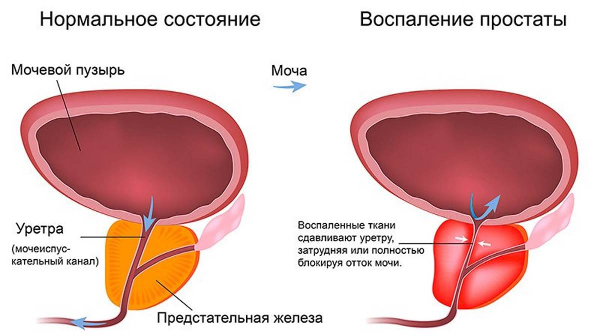 Мочеиспускание у мужчин: влияние воспаления, питания, питья