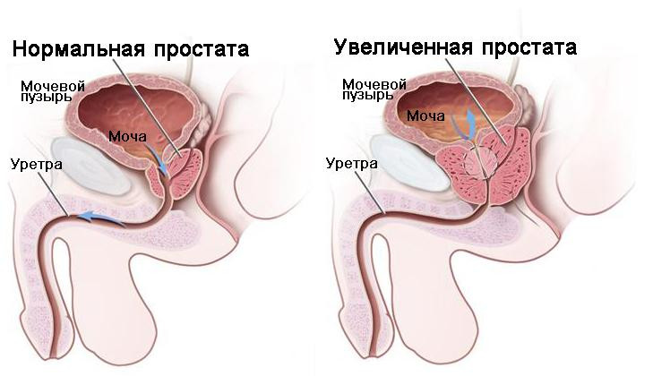 Бывает ли простатит у женщин?