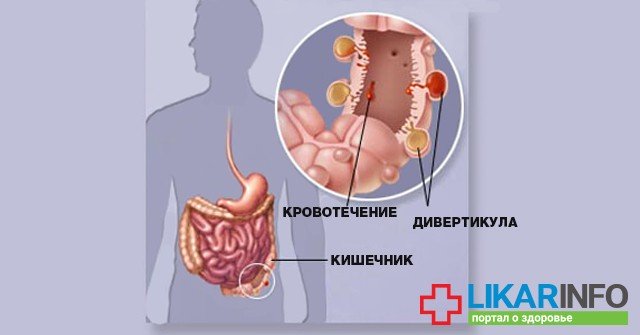 изжога от марихуаны
