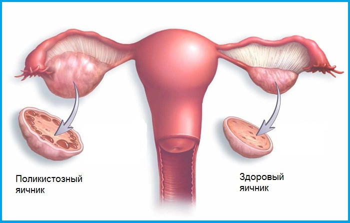 СПКЯ: причины, симптомы, как забеременеть