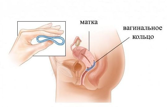 Контрацептивного вагинального кольца - цена введения в ОН КЛИНИК