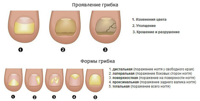 Стадии Грибка На Ногтях Ног Фото