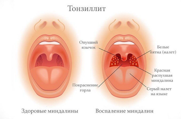 Где Находятся Миндалины В Горле Фото