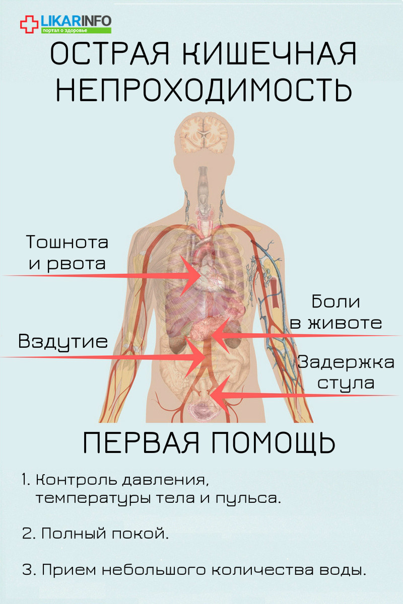 Боли в животе задержка стула. Острая кишечная непроходимость симптомы. Кишечная непроходимость симптомы. Признаки острой непроходимости кишечника. Симптомы при острой кишечной непроходимости.